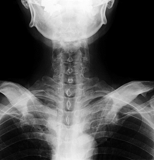 背中の痛み事例『首が痛い　ムチウチ症』