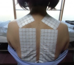 肩甲骨の治療