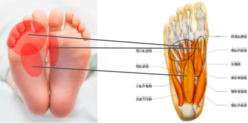 足の裏、土踏まずに痺れがある2