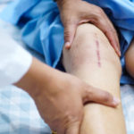 膝痛の手術