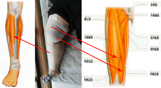 膝痛の手術を勧められた患者さんの痛みの原因