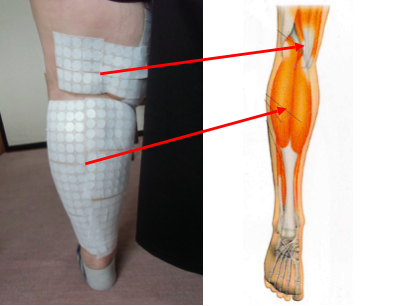 膝痛の手術を勧められた患者さんの痛みの原因２