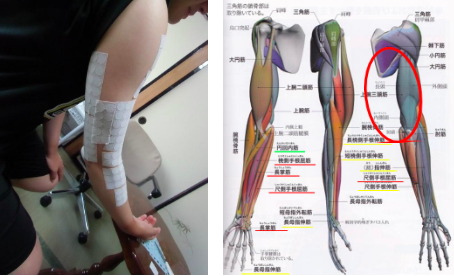 スポーツ障害で病院でも改善しなかった肘の痛み